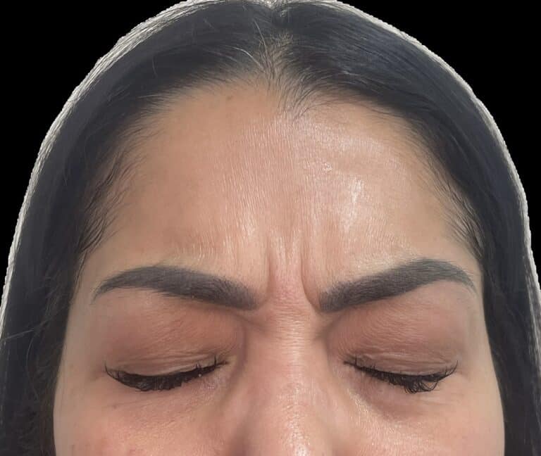 Before Image: Botox - front
