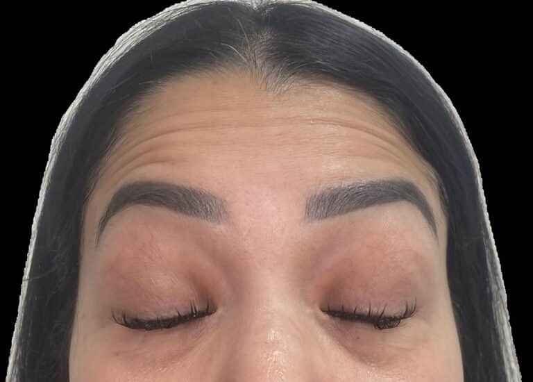 Before Image: Botox - front