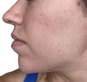 After Image: Dermal Fillers