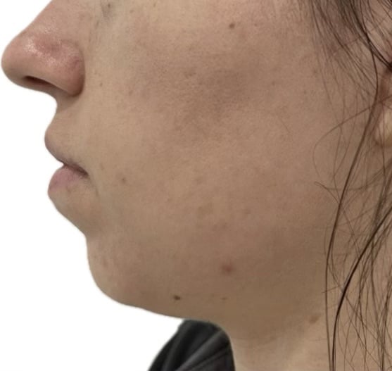 Before Image: Dermal Fillers - left-side