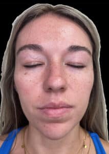 After Image: Dermal Fillers