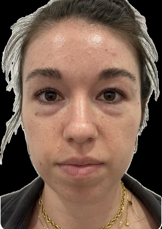 Before Image: Dermal Fillers - front