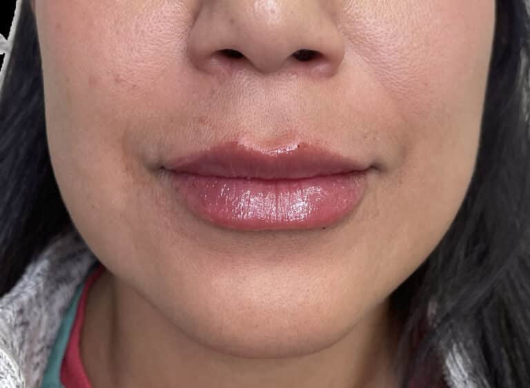 After Image: Dermal Fillers - front