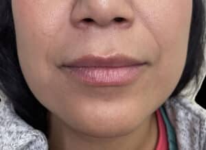 Before Image: Dermal Fillers