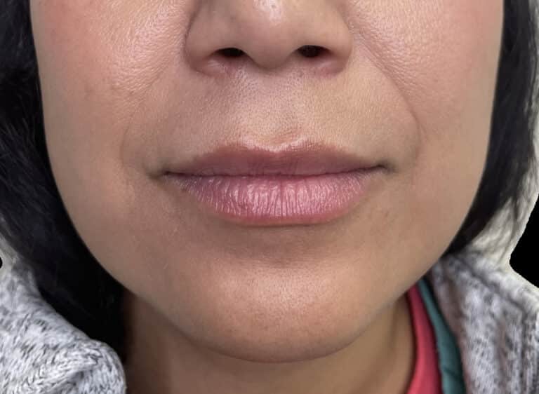 Before Image: Dermal Fillers - front