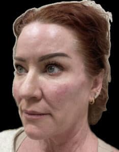 After Image: Dermal Fillers