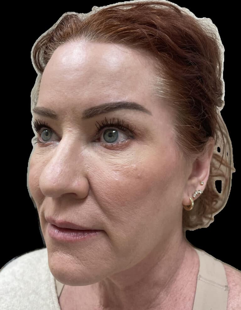 Before Image: Dermal Fillers - left-front-oblique