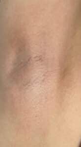 After Image: Laser Hair Reduction