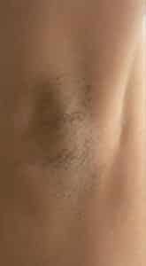 Before Image: Laser Hair Reduction