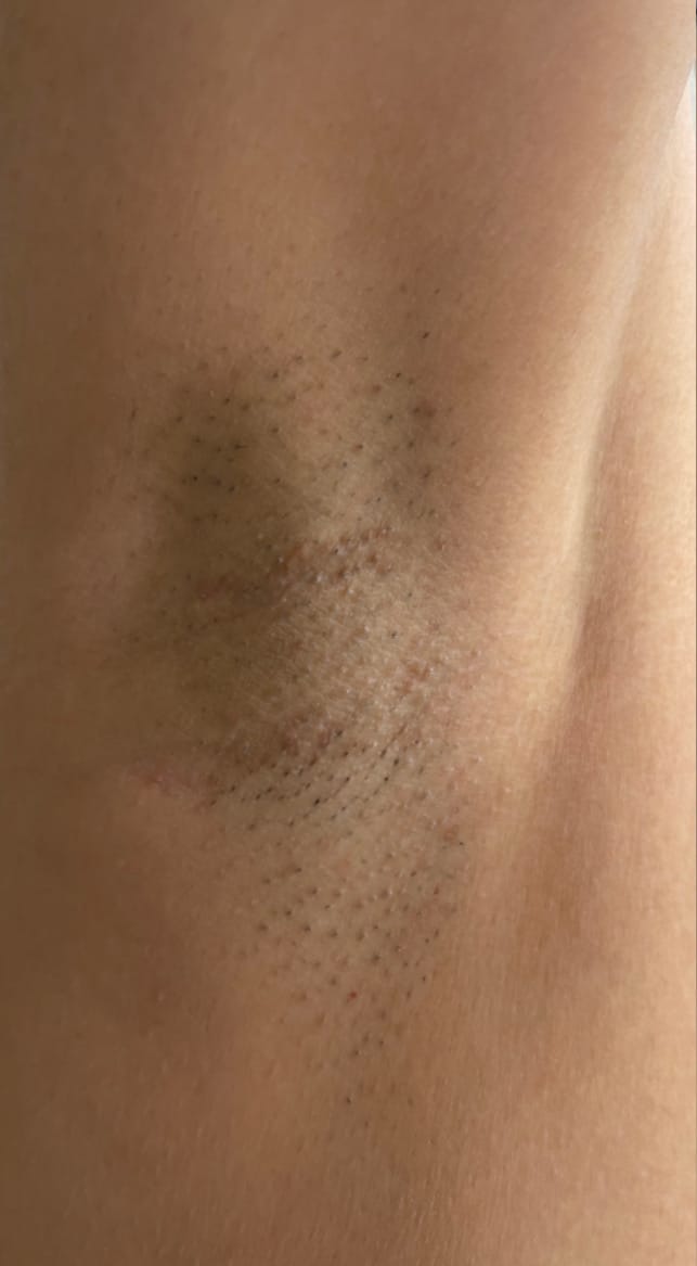 Before Image: Laser Hair Reduction - front