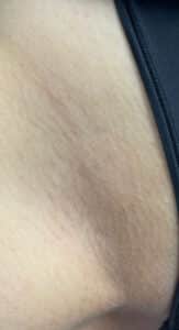 After Image: Laser Hair Reduction