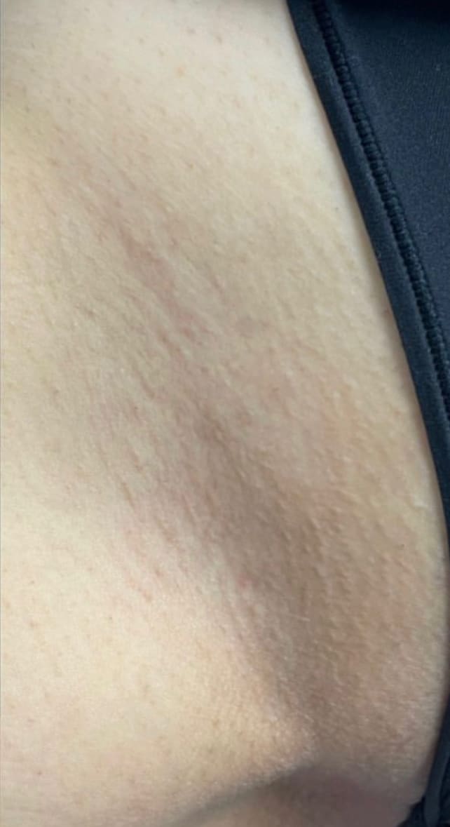 After Image: Laser Hair Reduction - front