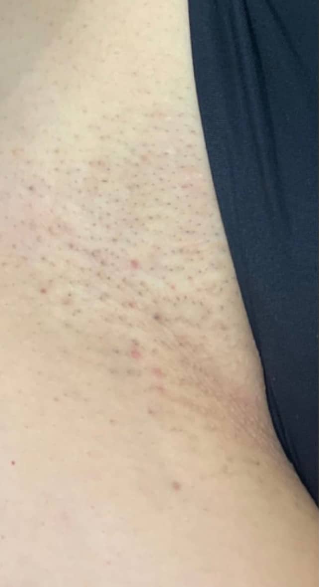 Before Image: Laser Hair Reduction - front