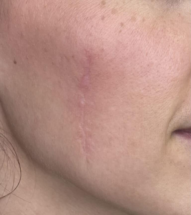 After Image: Microneedling - right-front-oblique
