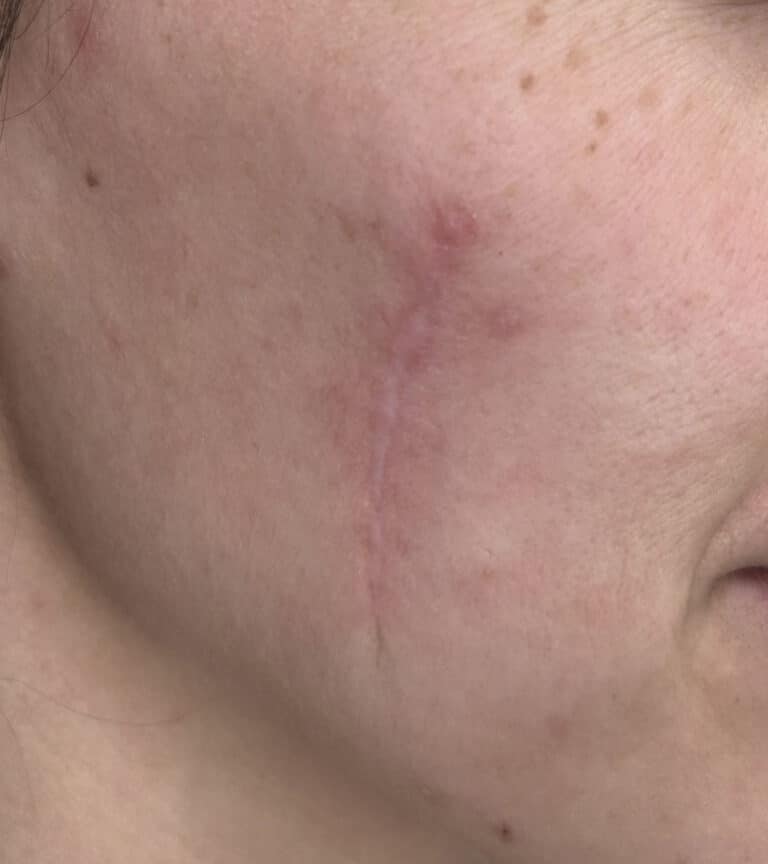 Before Image: Microneedling - right-front-oblique